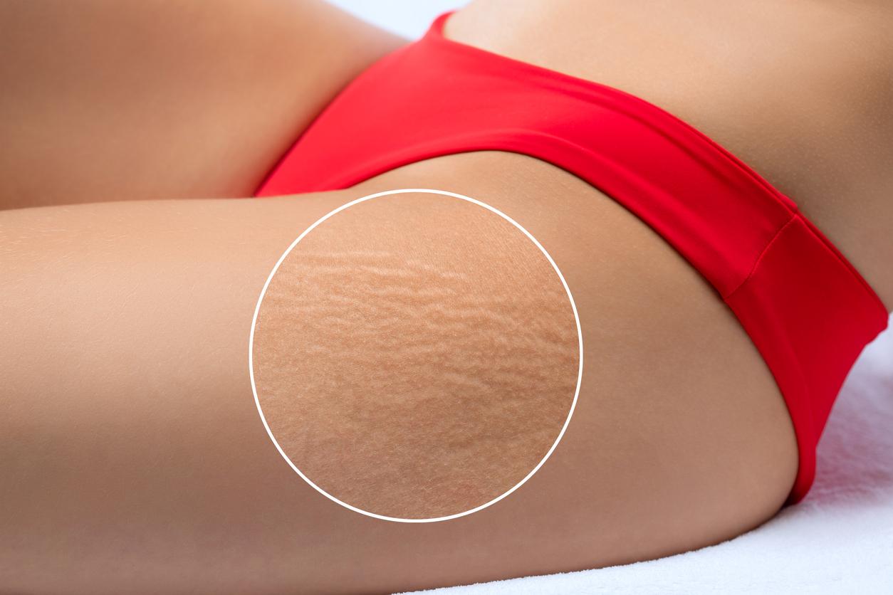 Female thighs with highlighted area showing stretch marks after weight loss