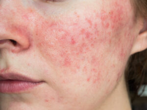 Woman with red skin looking for the best treatment for rosacea