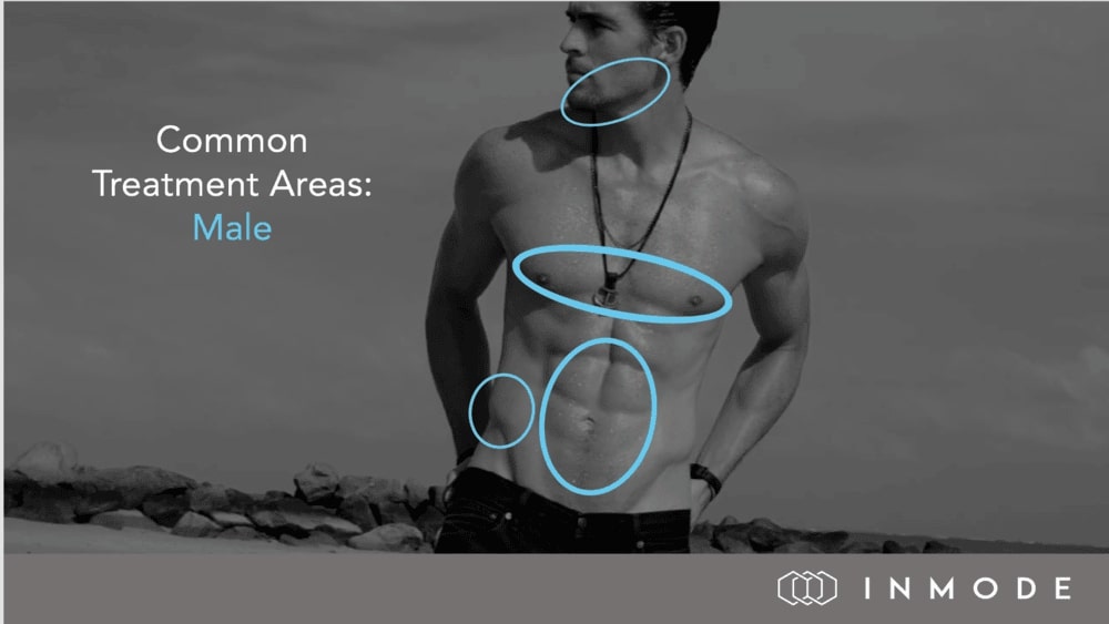 INMODE - Male Common Treatment Areas