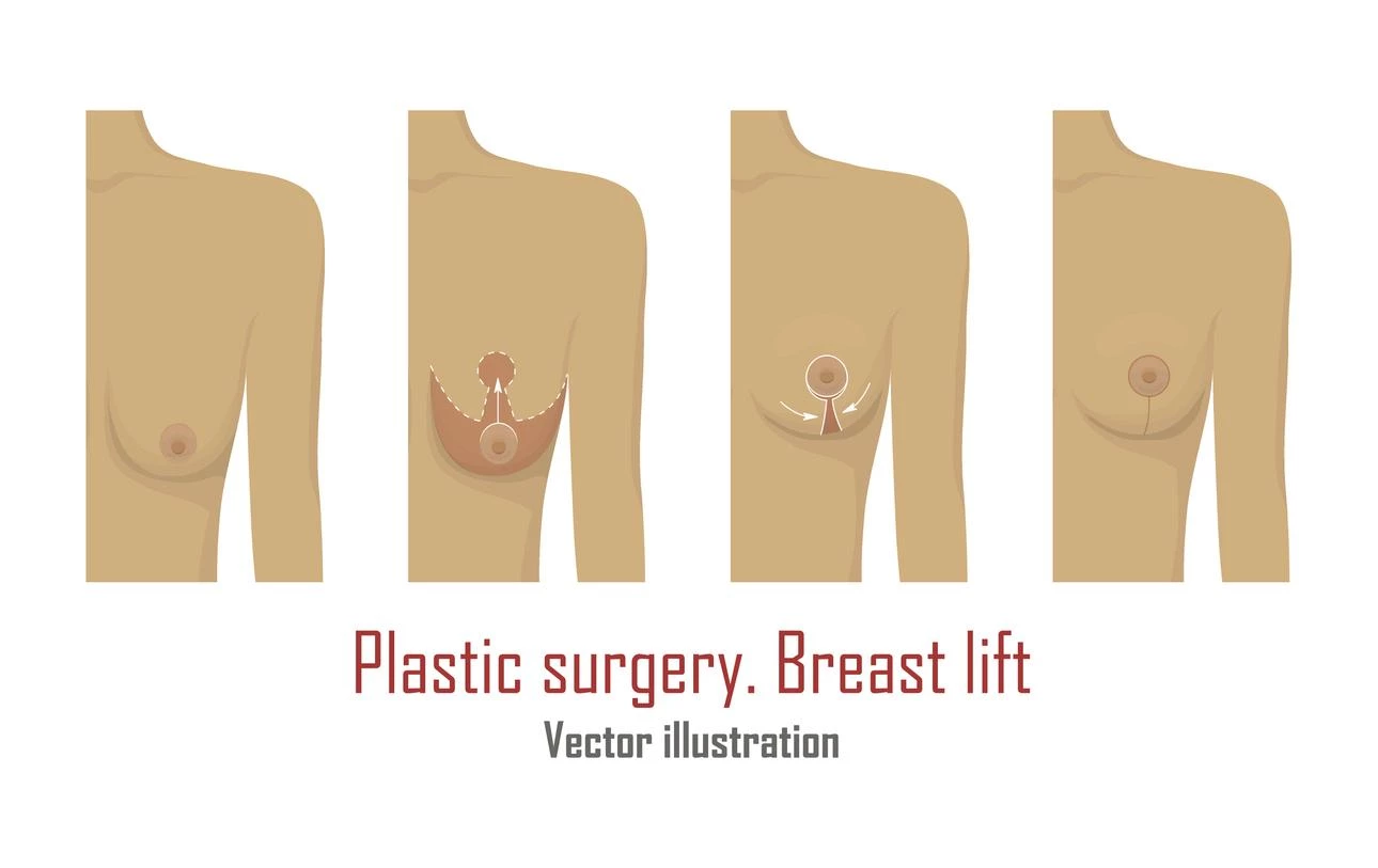 Enhance Your Curve Appeal with the Best Breast Lift in Chicago
